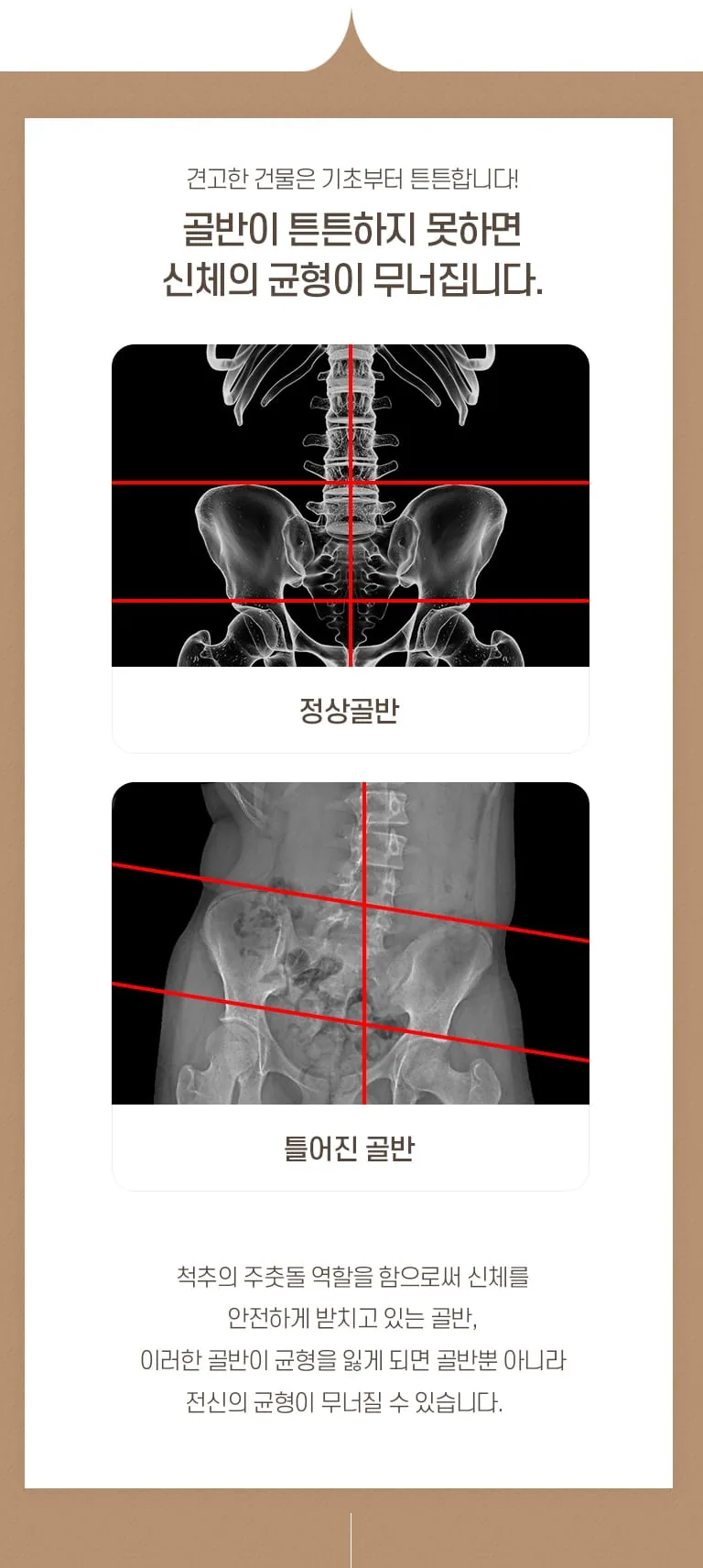 정상 골반과 틀어진 골반의 X-ray 비교 인포그래픽. 골반 균형이 신체 전신 균형에 영향을 준다는 설명. 견고한 건물은 기초부터 튼튼합니다! 골반이 튼튼하지 못하면 신체의 균형이 무너집니다. 정상골반 틀어진 골반 척추의 주춧돌 역할을 함으로써 신체를 안전하게 받치고 있는 골반, 이러한 골반이 균형을 잃게 되면 골반뿐 아니라 전신의 균형이 무너질 수 있습니다.