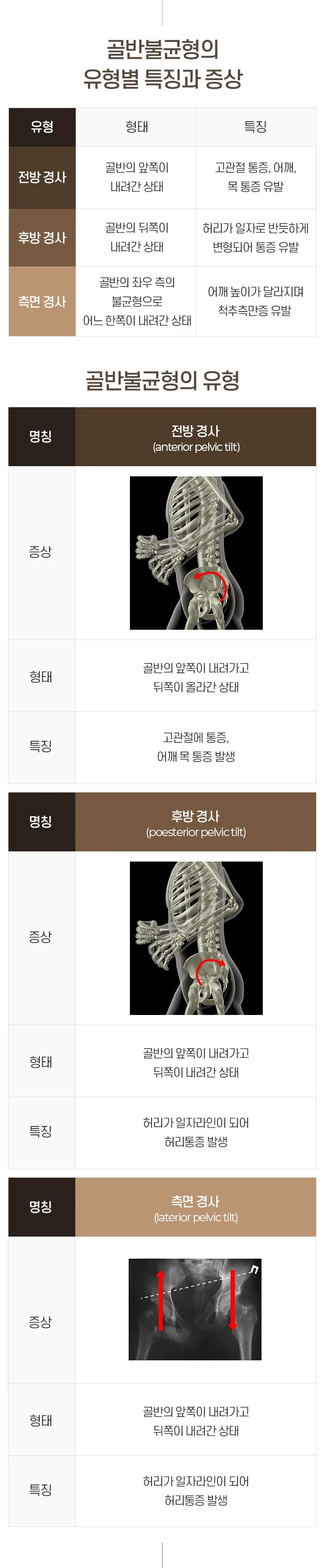 골반 불균형 유형(전방·후방·측면 경사)별 형태와 특징을 정리한 표와 골격 이미지로 구성된 골반 교정 추나 안내 인포그래픽. 골반불균형의 유형별 특징과 증상 유형 전방 경사, 형태 골반의 앞쪽이 내려간 상태, 특징 고관절 통증, 어깨, 목 통증 유발 / 유형 후방 경사, 형태 골반의 뒤쪽이 내려간 상태, 특징 허리가 일자로 반듯하게 변형되어 통증 유발 / 유형 측면 경사, 형태 골반의 좌우 측의 불균형으로 어느 한쪽이 내려간 상태, 특징 어깨 높이가 달라지며 척추측만증 유발 골반불균형의 유형 명칭 전방 경사 (anterior pelvic tilt), 증상, 형태 골반의 앞쪽이 내려가고 뒤쪽이 올라간 상태, 특징 고관절에 통증, 어깨 목 통증 발생 / 명칭 후방 경사 (poesterior pelvic tilt), 증상, 형태 골반의 앞쪽이 내려가고 뒤쪽이 내려간 상태, 특징 허리가 일자라인이 되어 허리통증 발생 / 명칭 측면 경사 (laterior pelvic tilt), 증상, 형태 골반의 앞쪽이 내려가고 뒤쪽이 내려간 상태, 특징 허리가 일자라인이 되어 허리통증 발생