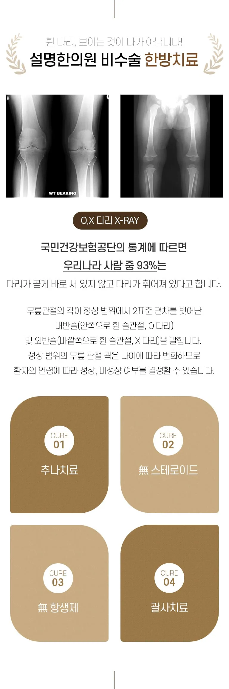 휜다리(O다리·X다리) 비수술 한방치료 안내. O·X 다리 X-RAY 사진과 내반슬·외반슬 설명, 추나치료·괄사치료 구성을 담은 인포그래픽. 휜 다리, 보이는 것이 다가 아닙니다! 설명한의원 비수술 한방치료 O,X 다리 X-RAY 국민건강보험공단의 통계에 따르면 우리나라 사람 중 93%는 다리가 곧게 바로 서 있지 않고 다리가 휘어져 있다고 합니다. 무릎관절의 각이 정상 범위에서 2표준 편차를 벗어난 내반슬(안쪽으로 휜 슬관절, O 다리) 및 외반슬(바깥쪽으로 휜 슬관절, X 다리)을 말합니다. 정상 범위의 무릎 관절 곽은 나이에 따라 변화하므로 환자의 연령에 따라 정상, 비정상 여부를 결정할 수 있습니다. CURE 01 추나치료 CURE 02 無 스테로이드 CURE 03 無 항생제 CURE 04 괄사치료